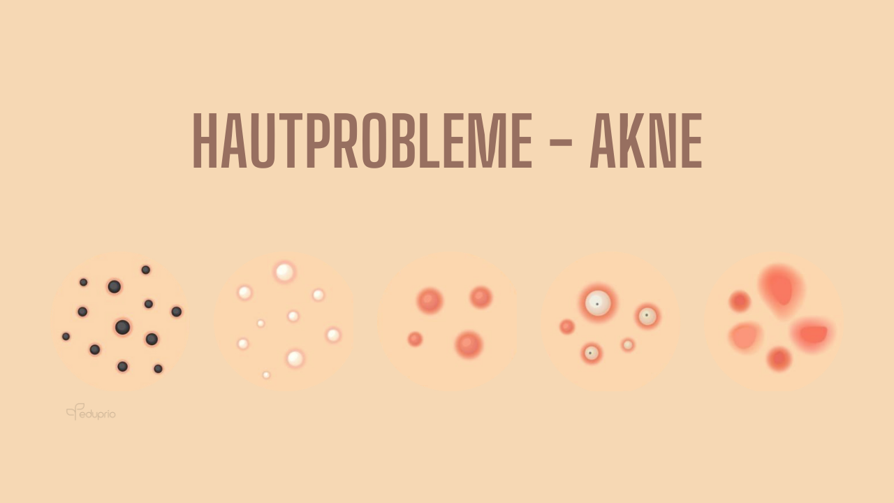 Hautprobleme_Akne